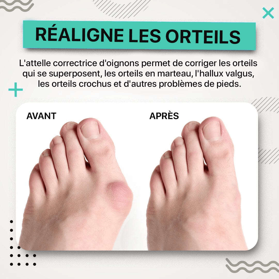 Correcteurs pour l'hallux valgus Vulaura