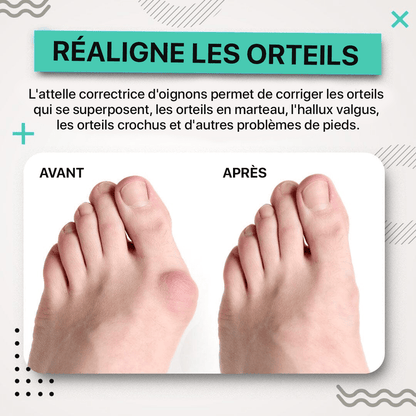 Correcteurs pour l'hallux valgus Vulaura